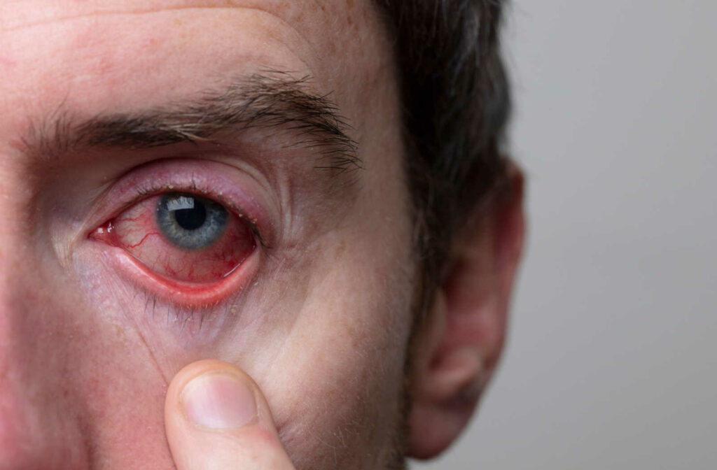 A close-up of a man's severely bloodshot eye from sleeping in contact lenses