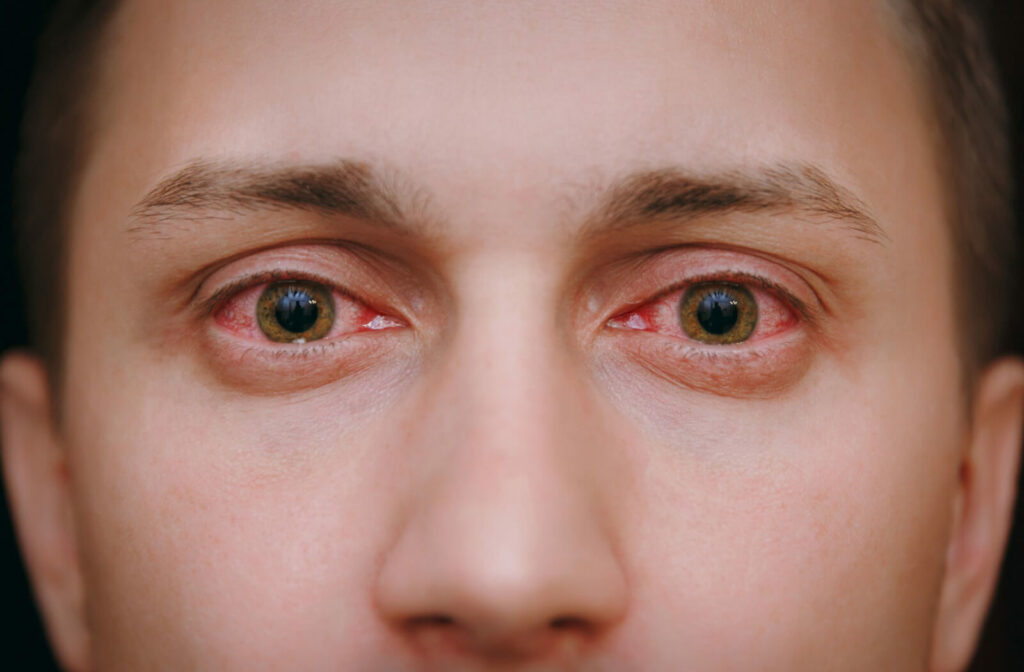 A close-up of a man with red eyes due to allergies.