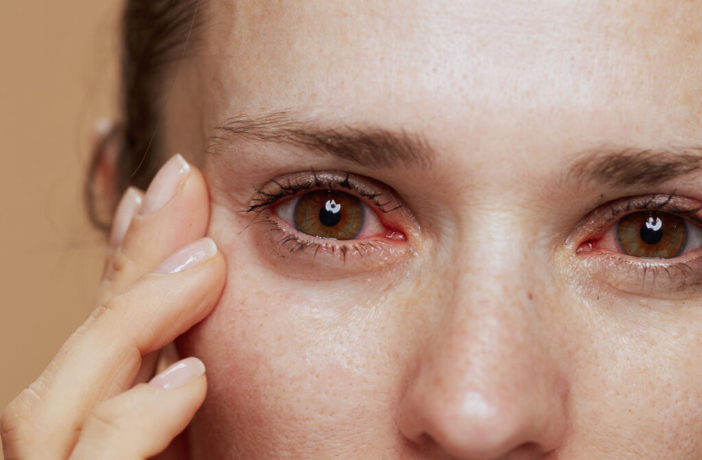 A close-up of a young woman with inflamed, irritated, and red eyes