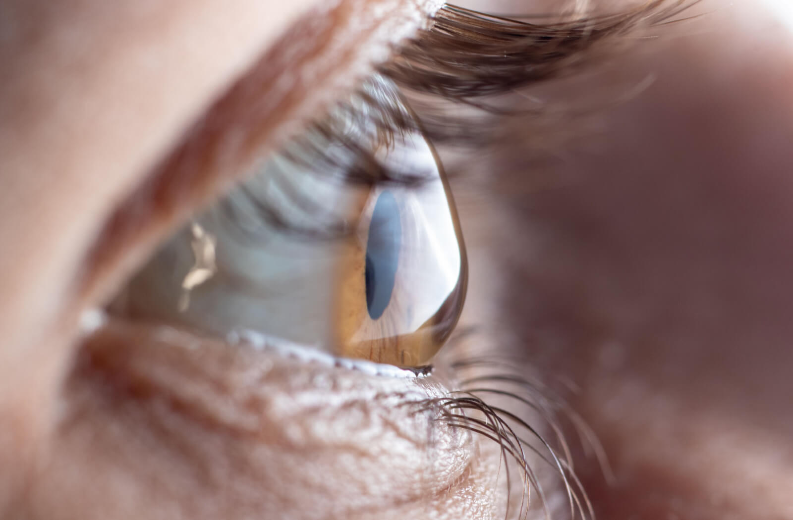 A close up of an eye with astigmatism.