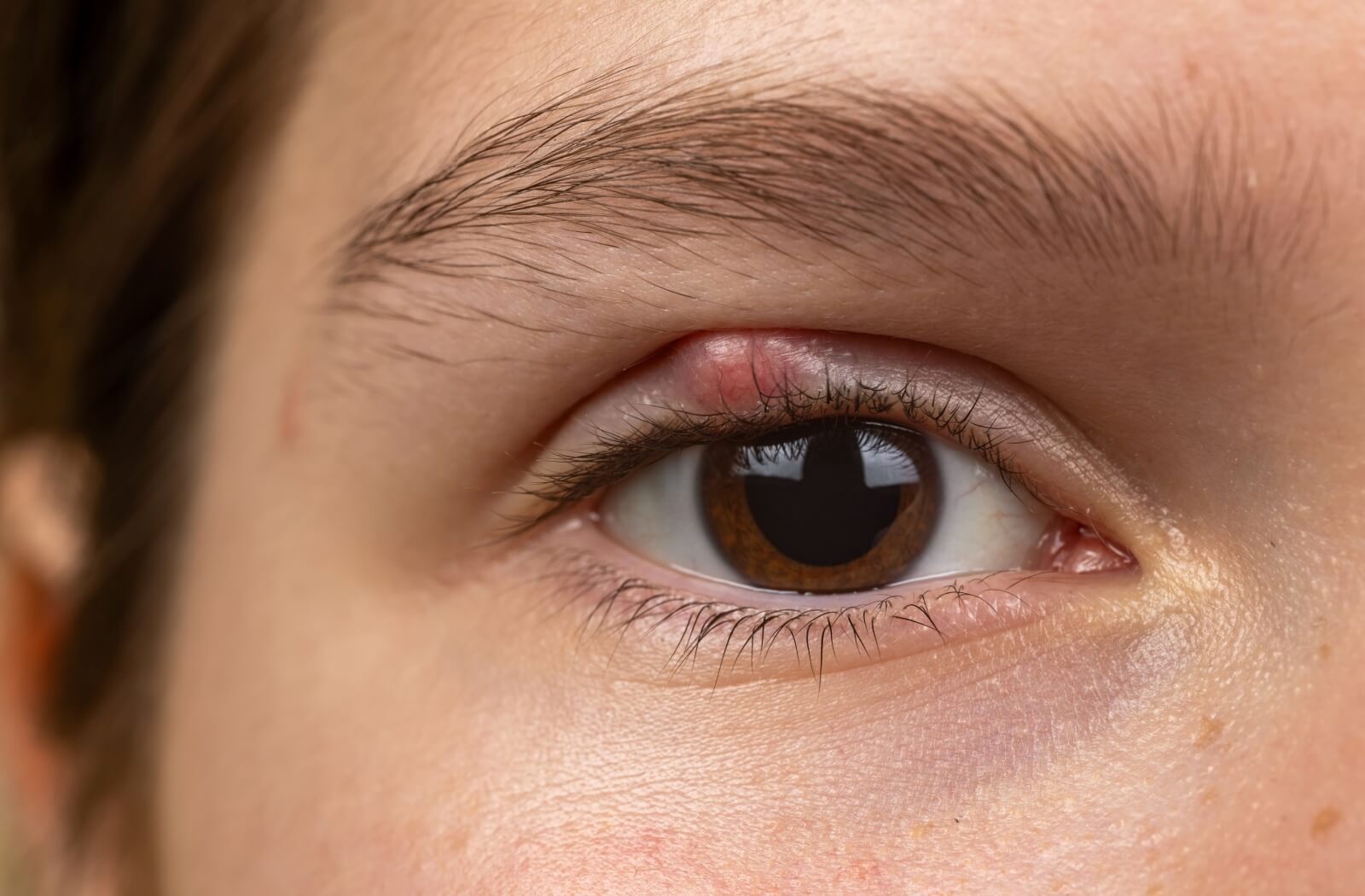 Close-up of an eye showing irritation along the eyelid margin.